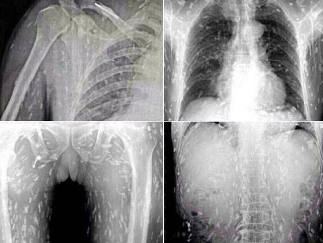xray of a mans body infested with parasites after eating sushi